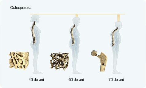 osteoporoza